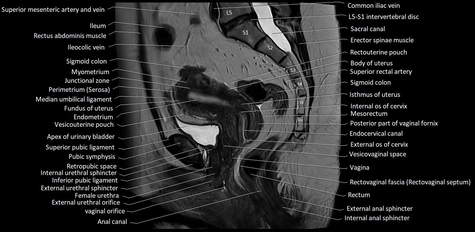 Sagittal cross sectional anatomy of female pelvis (MRI 3T) image 21.webp